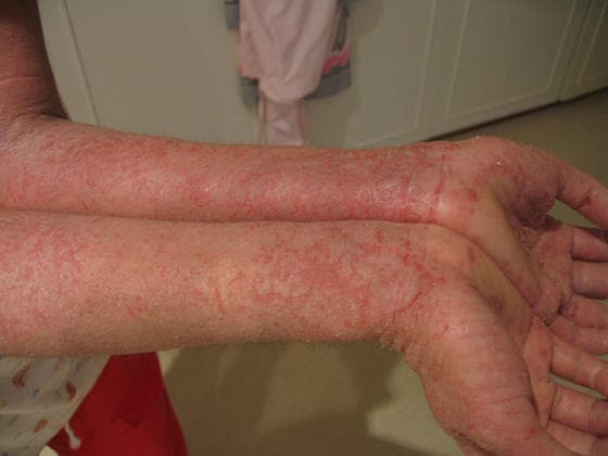 Coping with Atopic Dermatitis