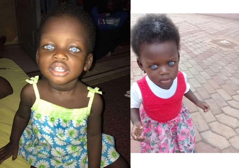This African girl born with blue eyes is a victim of ignorance