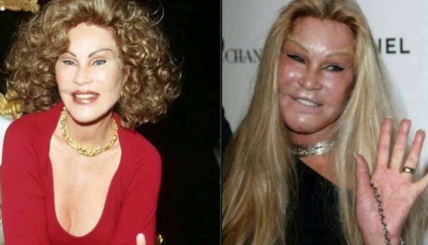 Sierra Gates Before And After Surgery
