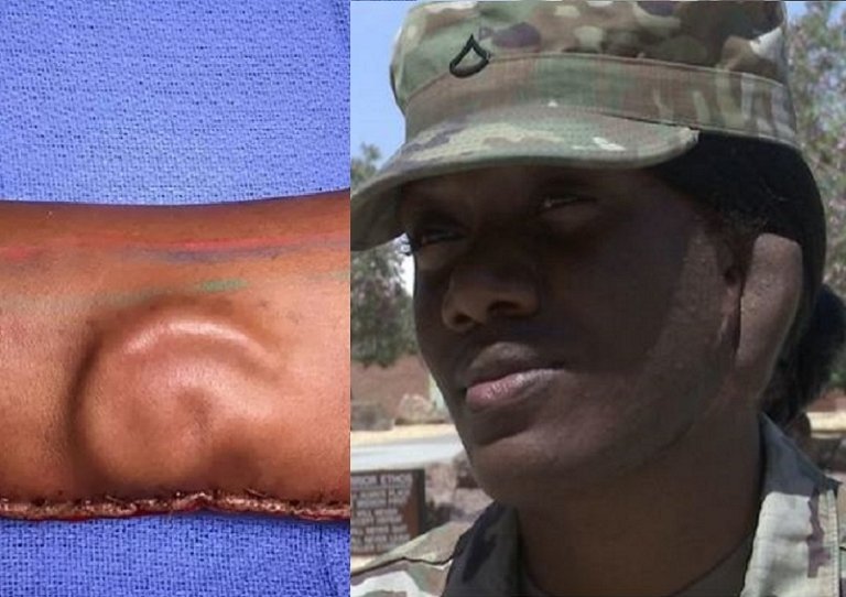 21yearold injured U.S. soldier gets new ear grown from her arm