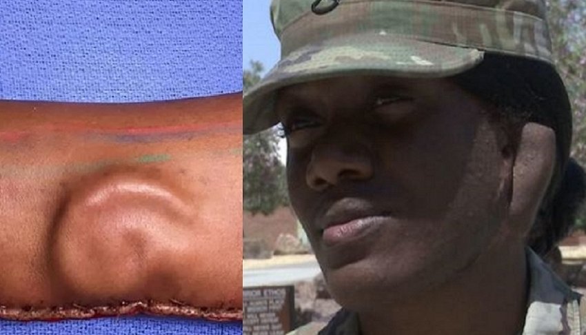 21-year-old injured U.S. soldier gets new ear grown from her arm
