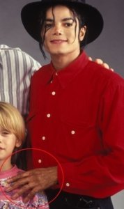 How Michael Jackson struggled with vitiligo and turned white