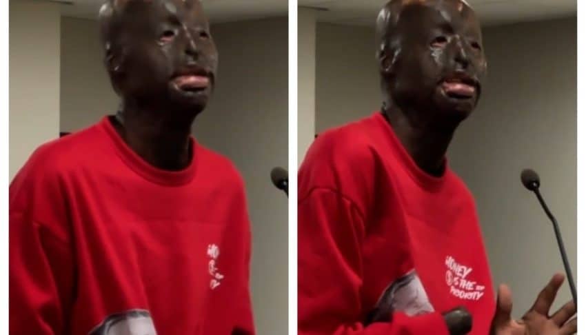 Burn survivor accused of murder claims innocence, says ‘these hands can’t pull a trigger’